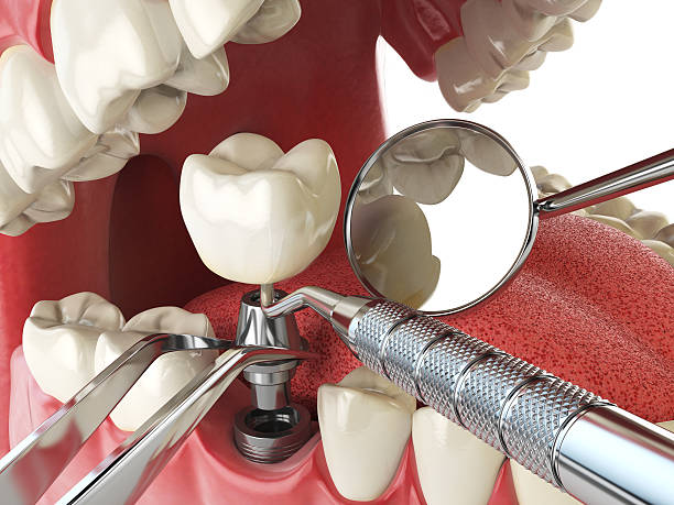 Best Lost Filling or Crown Replacement in Woodmore, MD